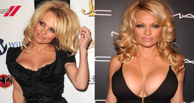 Is Pamela Anderson Before and After Breast Implants Photo Issue Right?