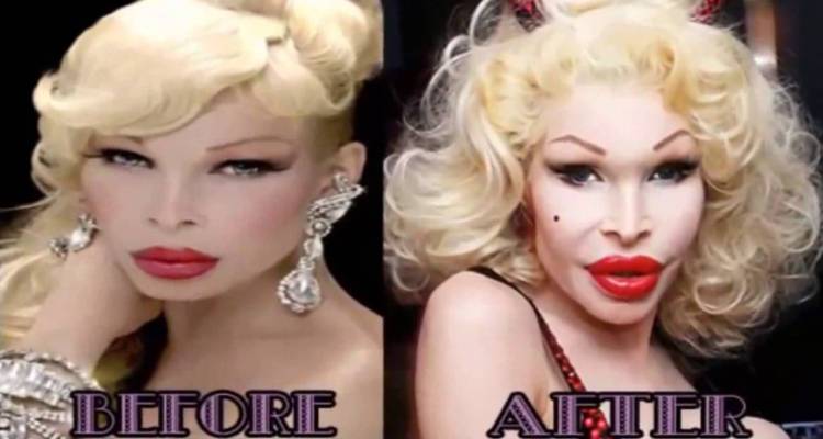 Amanda Lepore Before and After Lip Injections