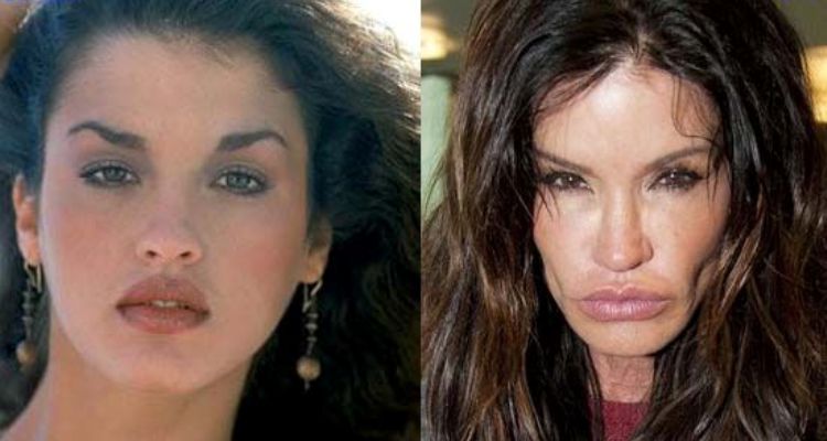 Ruined Janice Dickinson Before and After Lip Injections