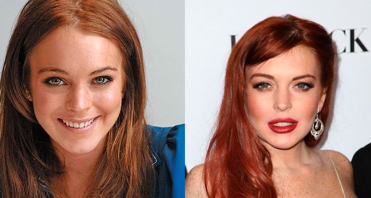 Lindsay Lohan Before and After Lip Injections