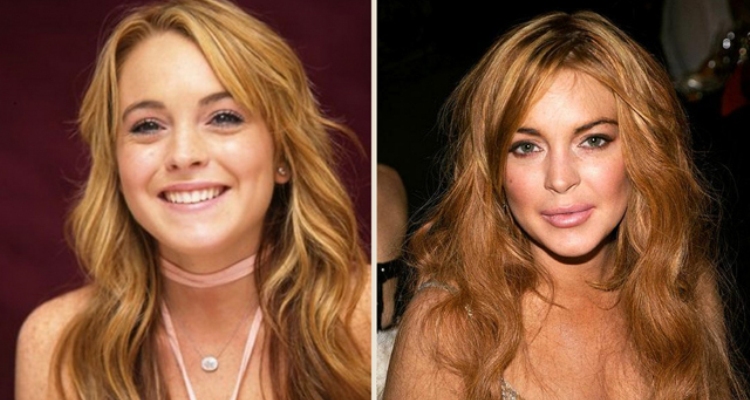 Lindsay Lohan Before and After Lip Injections