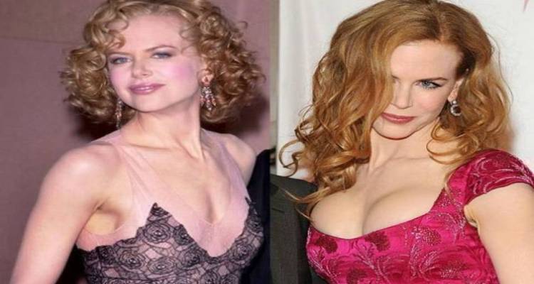 Nicole Kidman Before and After Breast Implants