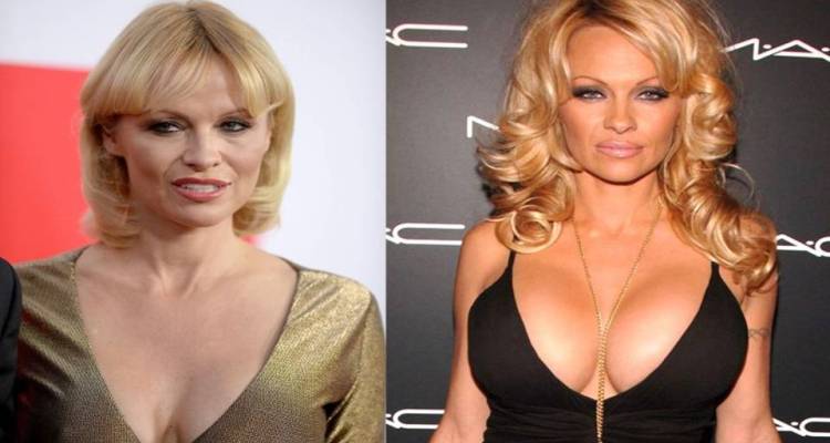 Is Pamela Anderson Before and After Breast Implants Photo Issue Right?