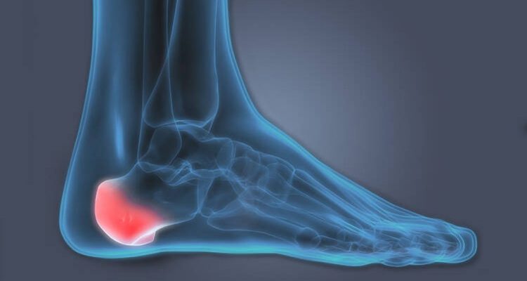 What are the Bone Spurs in Heel Symptoms?