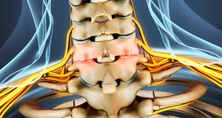 Bone Spurs in Neck Surgery Risks and Result