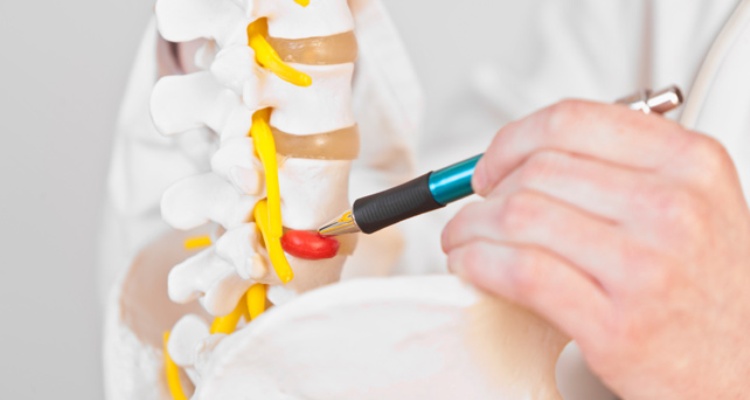 How Long Does Cervical Herniated Disc Surgery Recovery Time Take?