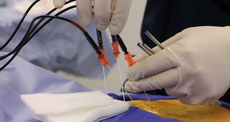 Having the Radiofrequency Ablation Procedure for Back Pain