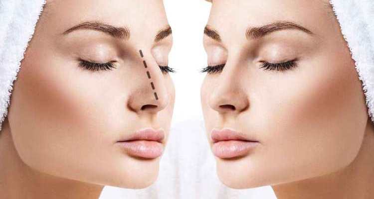 How Much is Rhinoplasty Cost, and What Should You Know About It?